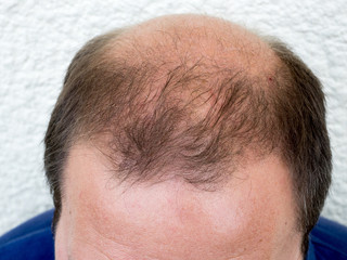 Baldness alopecia man loss haircare