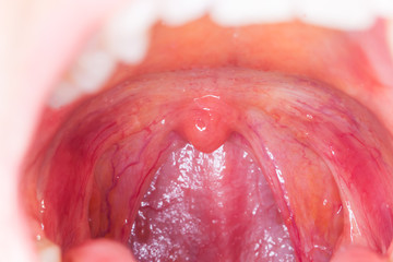 Fototapeta premium tonsilitis infection throat.macro opened mouth throat tonsil