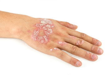 Psoriasis vulgaris on the male hand and finger nails with plaque, rash and patches, isolated on white background. Autoimmune genetic disease.