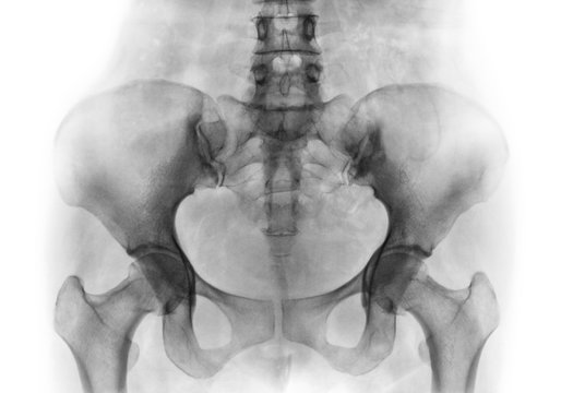 Film x-ray of normal human pelvis and hip joints