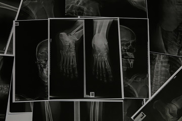 Xray right foot.X-ray foot collection show bone deformity in lateral and frontal view.