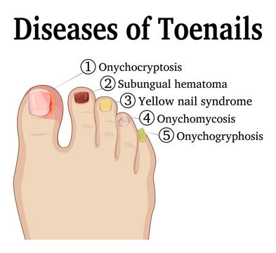 Diseases of Toenails