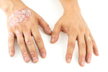 Psoriasis vulgaris on the mans hands with plaque, rash and patches, isolated on white background. Autoimmune  genetic disease.