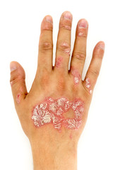 Psoriasis vulgaris on the man hand and finger nails with plaque, rash and patches, isolated on white background. Autoimmune genetic disease.
