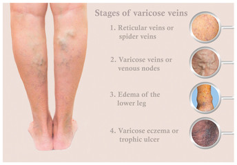 Varicose veins on a female senior leg