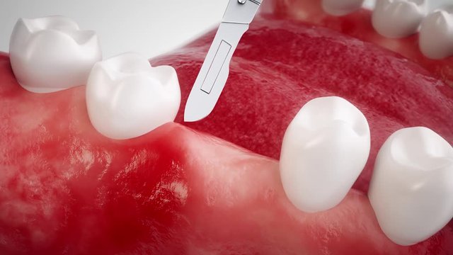 Dental implant - High end animation - NO HUMAN
In this animation film, you will see all the steps for using a dental implant. The film was created with the greatest possible care.
