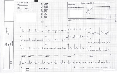 EKG, ecg graph, Electrocardiogram ecg on paper