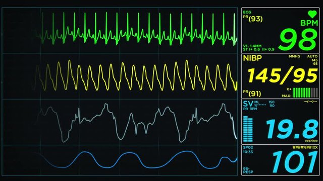 Medical monitor Screen Heart Attack Loop