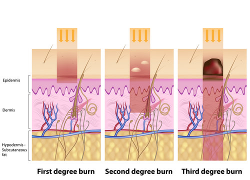 Skin burns degrees 