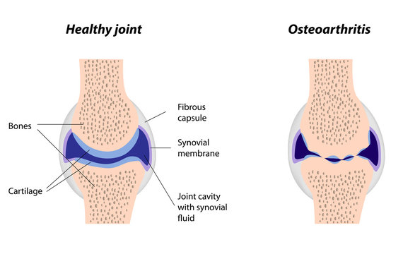 Synovial joint normal and arthritis