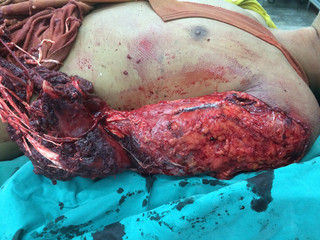Amputation wound injury left forearm.