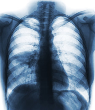 Pneumonia ( film chest x-ray show alveolar infiltrate at right middle lung )