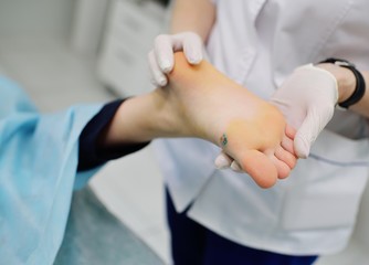 Doctor dermatologist examines the wart on the patient's foot - obrazy, fototapety, plakaty