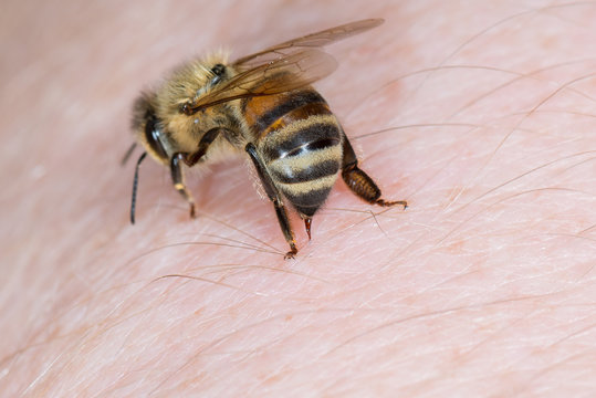 Eine Biene Honigbiene (Apis mellifera) sticht in die Hand