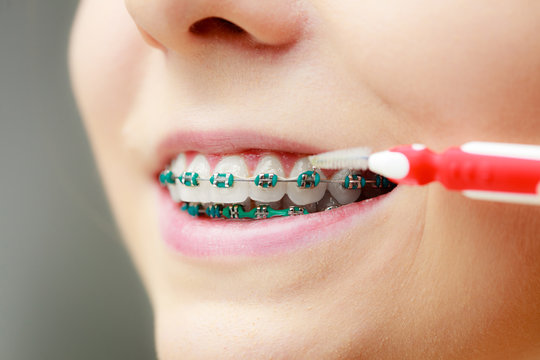 Woman with teeth braces using interdental brush