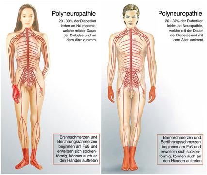 Neuropathie. So wirkt Diabetes auf den K&ouml;rper