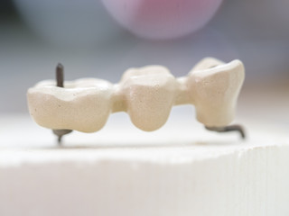 mplants teeth made in the technic Opaque porcelain dental. Oxidized metal opaque.