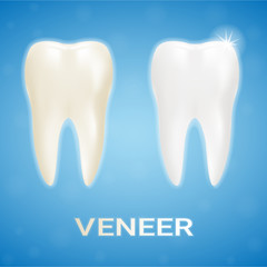 Tooth Veneer Whitening Dental Technician Isolated On A Background. Realistic Vector Illustration. Healthcare stomatology and cleaning professional teeth illustration