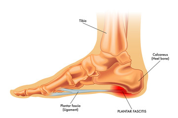 Vector medical illustration of symptoms of plantar fascitis