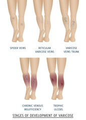 Types of varicose veins in women. Stages of development of varicose veins, vector illustration. - obrazy, fototapety, plakaty