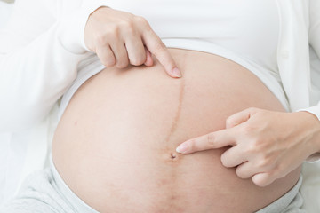 Black line on belly of pregnant women, Pregnancy line or Linea Nigra concept