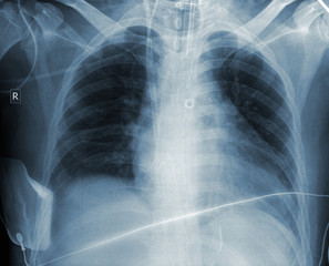 Radiogram result of patient chest