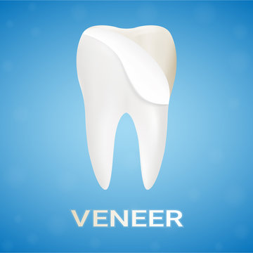 Dental Veneers On A Human Tooth Isolated On A Background. Realistic Vector Illustration. Healthcare stomatology and cleaning professional teeth illustration