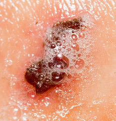 Fototapeta premium Wound on human skin in hydrogen peroxide