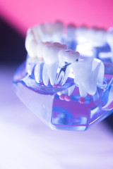 Dental tooth root canal