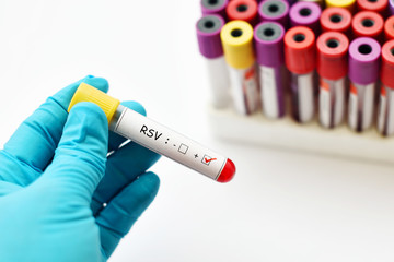Obraz premium Blood sample positive with respiratory syncytial virus (RSV)