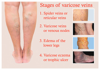 Varicose veins on a female senior leg