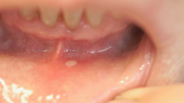 Disease in the mouth. Stomatitis into mouth on the lower lip. Close-up