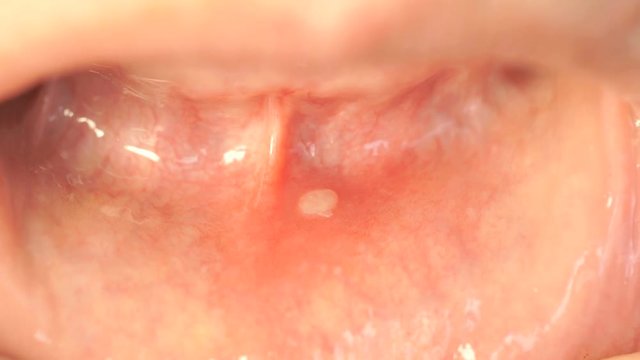 Close-up of stomatitis into mouth. Woman bends his lower lip and shows stomatitis