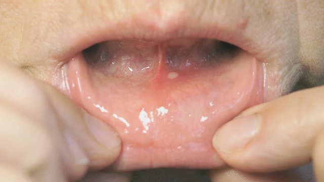 Disease in the mouth. Stomatitis into mouth on the lower lip. Close-up