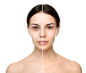 Young woman before and after exhaustion caused by sleep deprivation on white background