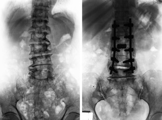 Spondylosis . Before and After surgery .