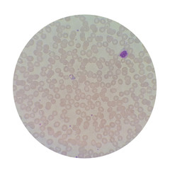 Microscopic examination of thin blood films smear from malaria infected patients present ...