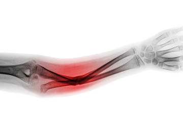 Obraz na płótnie Canvas Film x-ray forearm AP show fracture shaft of ulnar bone