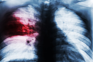 Lobar Pneumonia . Film chest x-ray show patchy infiltrate at right middle lung from Mycobacterium tuberculosis infection ( Pulmonary tuberculosis ) .