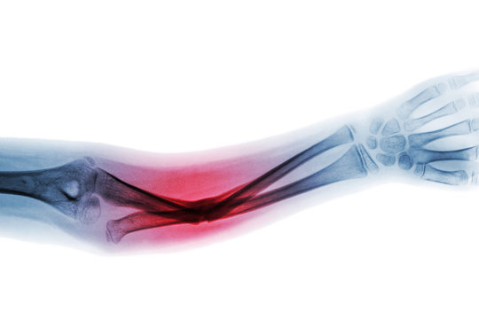 Film x-ray forearm AP show fracture shaft of ulnar bone