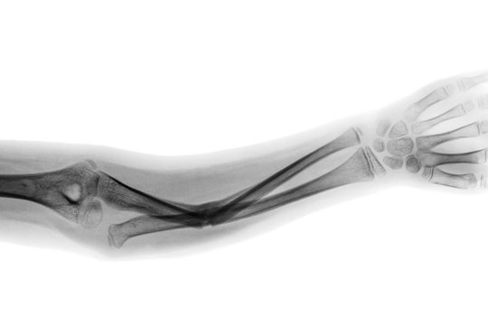 Film x-ray forearm AP show fracture shaft of ulnar bone