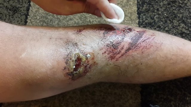 A wound on the leg of a man. First aid