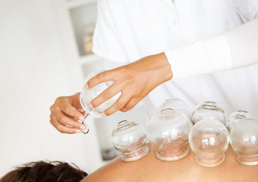 Alternative Medicine: Female Doctor Applying Suction Cups (Cupping)