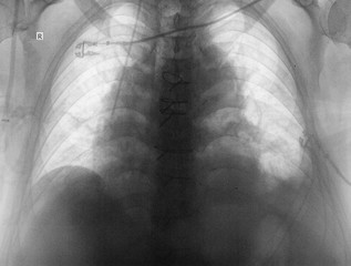 Radiograph of thoracic cavity organs