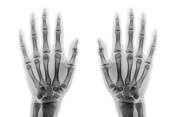 Film x-ray both hand AP show normal human hands on white background ( isolated )