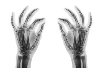 X-ray normal human hands on white background . Oblique view