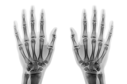 Film x-ray both hand AP show normal human hands on white background ( isolated )