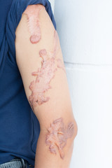 Fototapeta premium scar on his arm (scar from car accident)