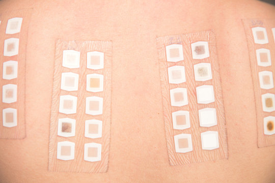 Alergy patch test on the back of a young woman