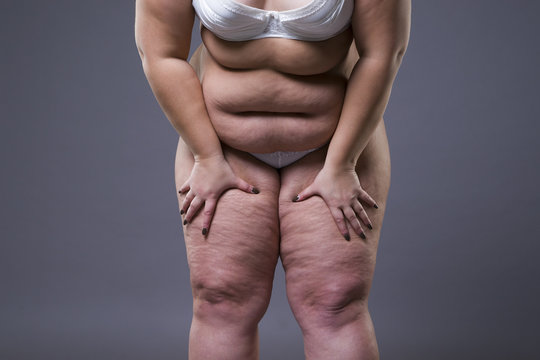 Overweight woman with fat legs, obesity female body
